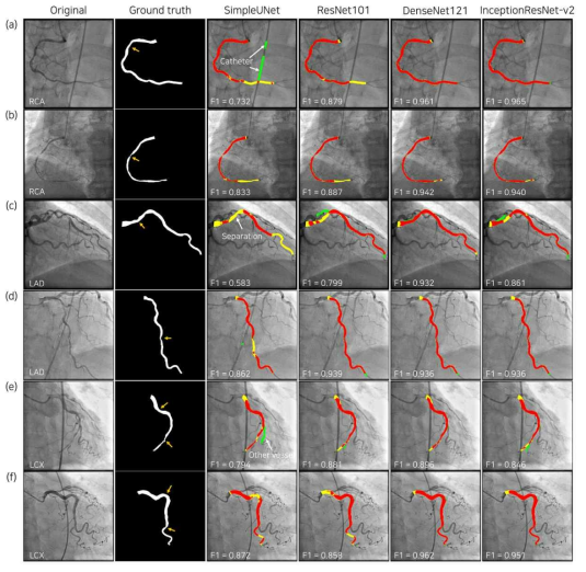 인공지능 기반 혈관 분할 알고리즘의 적용 (Yang et al., Scientific reports, 2019)