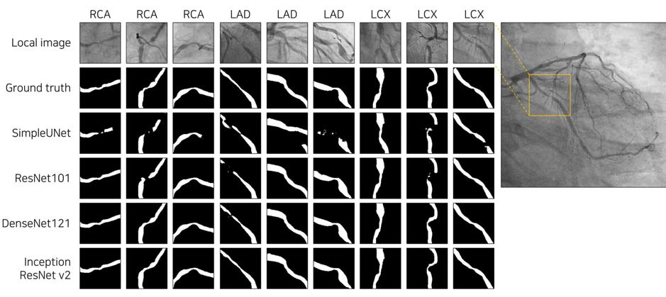 혈관이 좁아진 영역에서의 높은 분할 정확도 (Yang et al., Scientific reports, 2019)