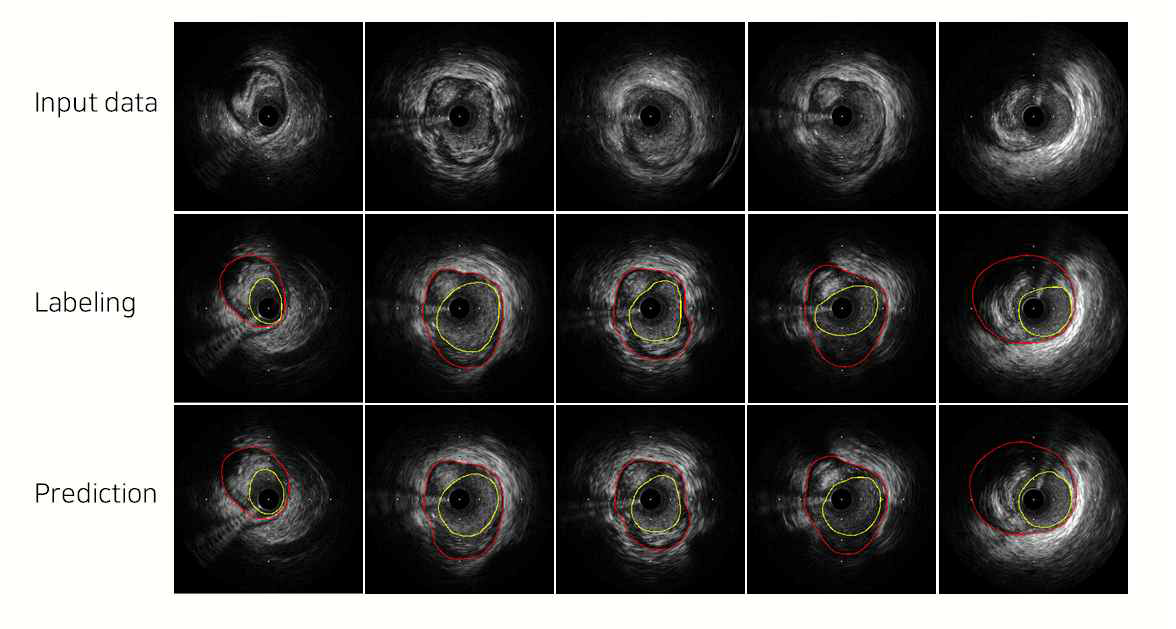 딥러닝 기반 혈관내초음파 영상 분할기술의 적용 결과 (Densenet121 + Unet architecture, Generalized dice coefficient as loss function)