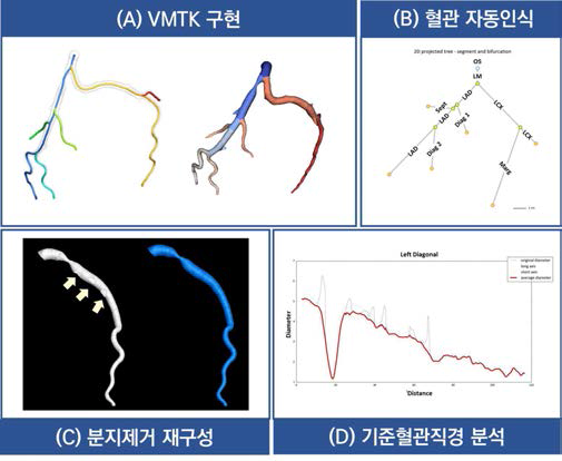 CT영상 기반 관상동맥 자동분석 소프트웨어의 개요