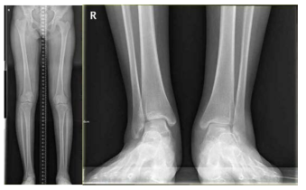 발목의 이상 정렬 상태와 무릎 관절의 이상정렬 상태를 확인할 수 있는 방사선 촬영