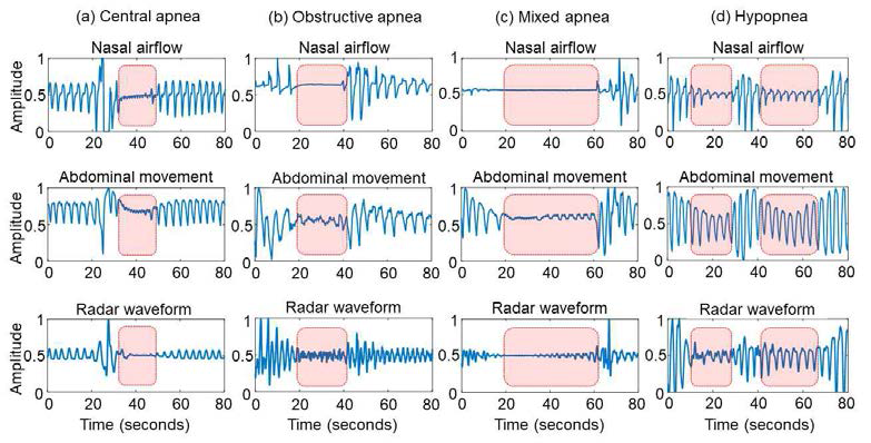 무호흡증 종류별 호흡 파형