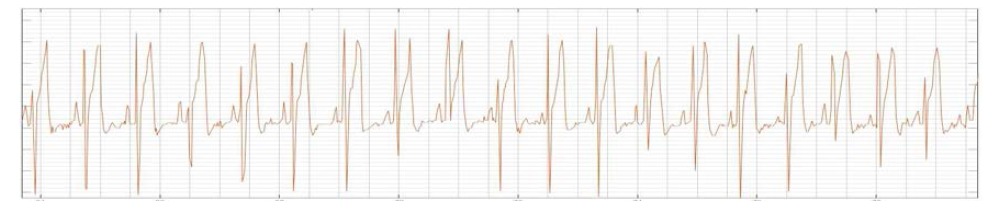 아두이노를 이용하여 획득한 ECG 데이터