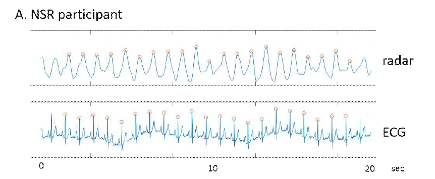 IR-UWB 레이더 센서와 ECG로 측정한 심박의 비교 그림