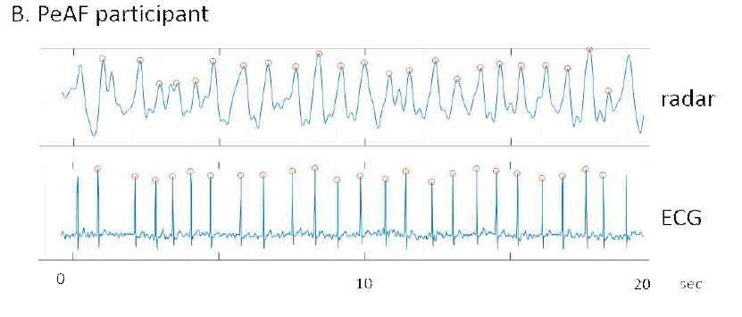IR-UWB 레이더 센서와 ECG로 측정한 심박의 비교 그림