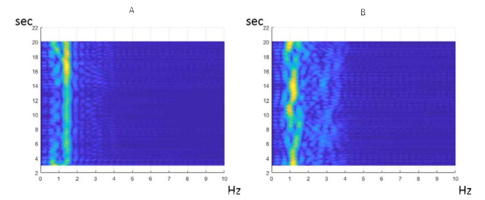 IR-UWB 레이더 센서로 측정한 정상인과 부정맥 환자의 심박 파형의 spectrogram