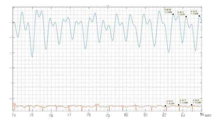 레이더로 측정한 심장파형과 ECG