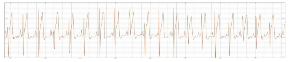 아두이노를 이용하여 획득한 ECG 데이터