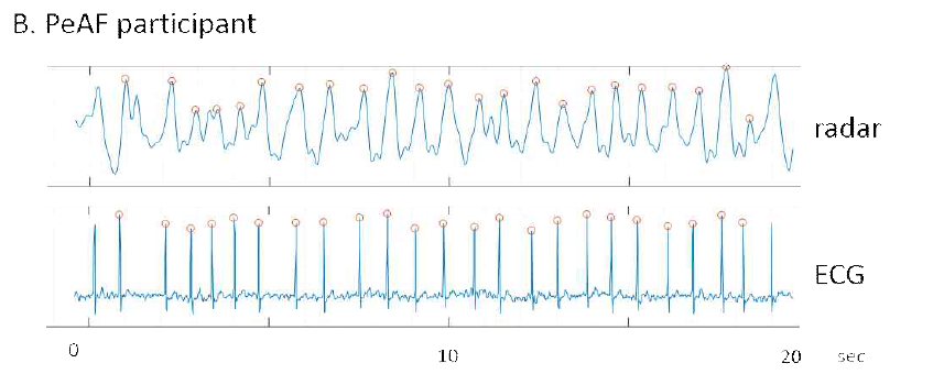 IR-UWB 레이더 센서와 ECG로 측정한 심박의 비교 그림