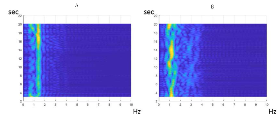 IR-UWB 레이더 센서로 측정한 정상인과 부정맥 환자의 심박 파형의 spectrogram