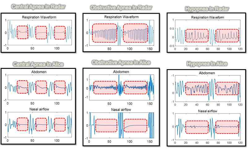 각각의 무호흡증 발생 시 Radar로 얻은 호흡파형과 기존 검사장비로 얻은 호흡파형 비교