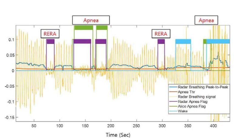 무호흡증 False Alarm 예시 : RERA