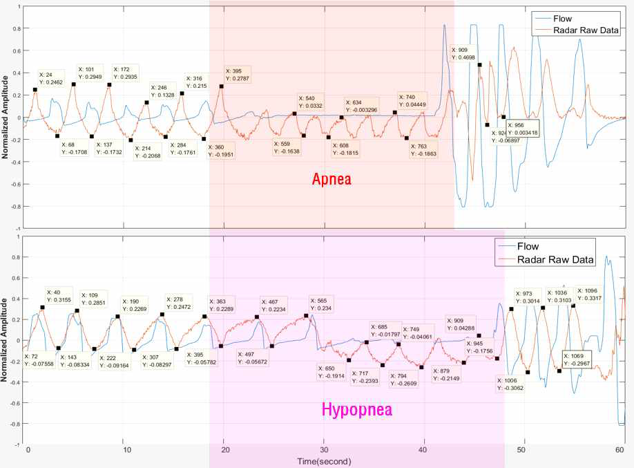 Apnea와 Hypopnea 발생 시 Radar 파형 변화 관찰