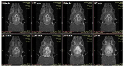 뇌실에 직접 주사한 가돌리늄 조영제(Gadovist)가 뇌실로부터 뇌척수액 순환경로를 통해 뇌전체로 확산되어 가는 과정의 순차적인 영상