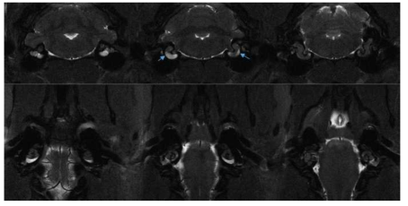 가돌리늄 조영제가 내이를 통해 조영증강 시키는 고해상도 MRI 영상