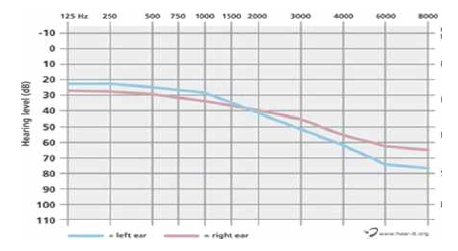 기존 고주파 영역에서 청력 감소를 보이는 1차원 audiogram