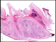 Pulp inflammation by access opening in rat