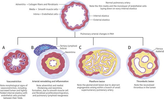 폐동맥고혈압의 병태생리 특징을 나타낸 모식도 (J Am Coll Cardiol 2015)