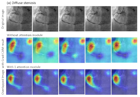 Grad-CAM을 이용한 심혈관 상태 판별 알고리즘의 해석 및 시각화