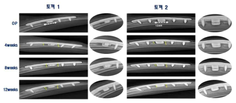 4주 간격으로 x-ray 촬영하여 관찰한 결과 생분해성 소재가 삽입된 결손부위에 뼈가 형성된 것을 관찰할 수 있었고, 금속 인공지지체도 수술부위에 고정되어 유지되는 것을 확인하였음