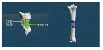 생분해성 소재 인공지지체의 응력을 강화하기 위해 인공지지체 내부에 금속 소재를 삽입한 모습