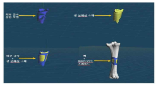 금속 소재의 외부 삽입을 적용한 최초 하이브리드 인공지지체 제작