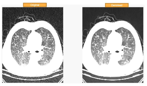 실제 환자의 저선량 흉부 CT 영상(좌)와 중화알고리즘을 이용하여 디노이징을 실행한 영상(우). 폐실질의 영상잡음이 뚜렷하게 감소하고, 영상 텍스쳐가 동질적으로 바뀐 것을 확인할 수 있음