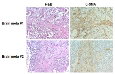폐암 뇌전이 샘플의 α-SMA 면역염색