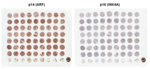 폐암의 TMA를 이용한 p14/ARF와 p16/INK4A 면역염색