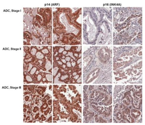 p14/ARF와 p16/INK4의 폐암 병기별 발현 양상