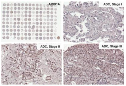 폐암에서 ARID1A의 발현 양상