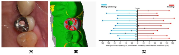 전소결 합금의 임상적용. (A) Application of presintered alloy, (B) 3D analysis, (C) Clinical results of misfit