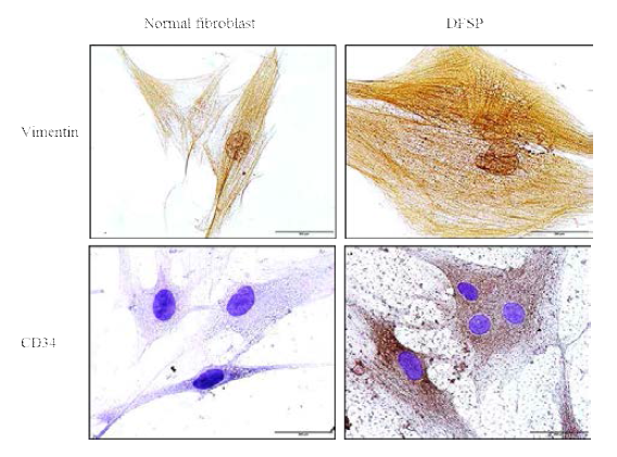 피부 섬유육종 조직을 이용한 융기성 피부섬유육종 세포의 일차 배양 세포에서 세포의 identity 확인을 위한 면역화학조직 염색 결과: Vimentin 에 양성을 보이고 CD34에 음성을 보이는 정상 섬유세포에 반해 피부 섬유육종 세포는 vimentin과 CD34 모두에 강한 양성을 나타냄