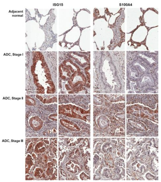 ISG15와 S100A4의 폐암 병기별 발현 양상