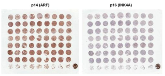 폐암의 TMA를 이용한 p14/ARF와 p16/INK4A 면역염색