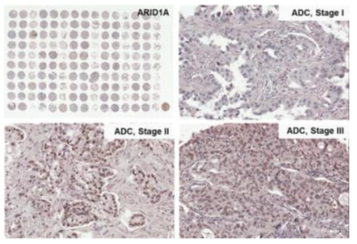 폐암에서 ARID1A의 발현 양상