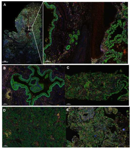 다중면역염색 (multiplexd IHC). A. Whole image, B-C. Adenocarcinoma, D-E. Squamous