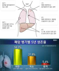 폐암의 병기 및 병기별 5년 생존율