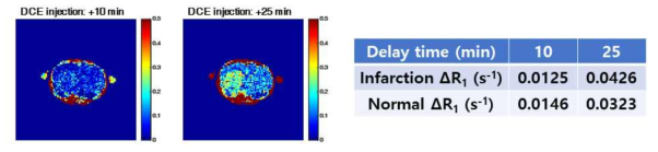 허혈성 뇌졸중 모델에서의 ΔT1 map 및 변병 지역과 정상지역의 평균 ΔR1 테이블