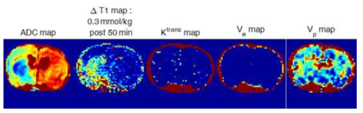 DCE-MRI 기법으로 측정한 Ktrans, Ve, Vp 맵과 물분자 확산계수 맵 (ADC map), 조영제의 관류 정도를 나타내는 ΔT1 맵 비교. ADC 맵과 ΔT1 맵에서는 병변지역과 정상지역의 차이가 보이지만, DCE-MRI기법은 구분할 수가 없음