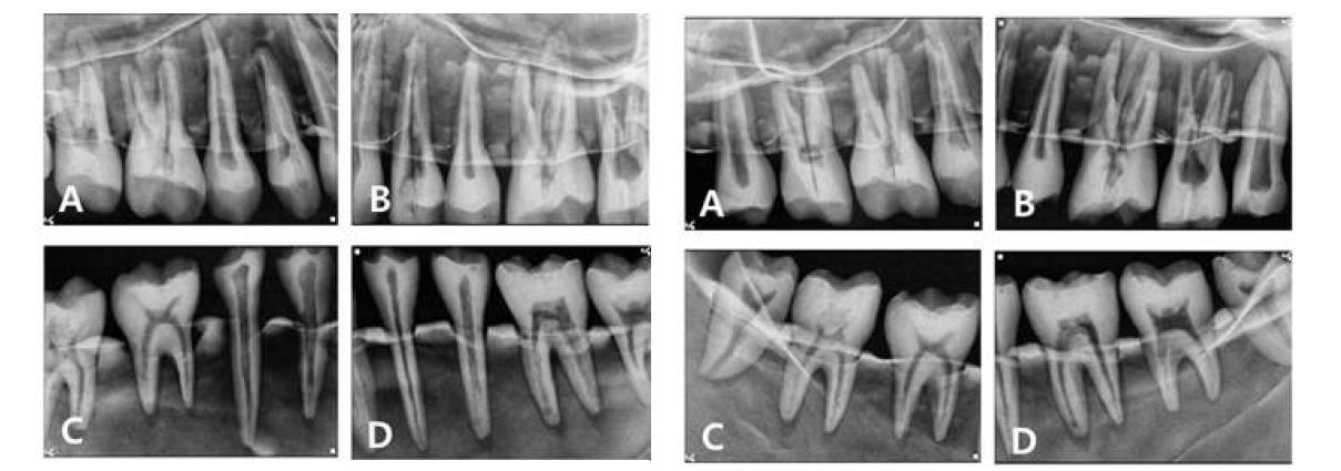 Dental phantom head의 소구치 방사선 사진(왼쪽), 대구치 방사선 사진(오른쪽)