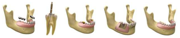 대표적인 치아의 질환별 종류에 대한 3D 모델링 자료