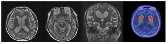 특발정상압수두증 환자의 뇌 자기공명영상과 도파민운반체(dopamine transporter) 영상