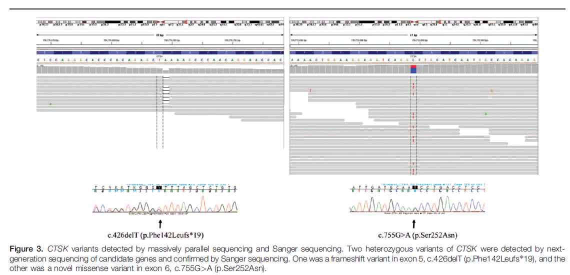 원인 유전자 CTSK를 규명한 골이형성증 가계의 NGS 및 Sanger sequencing 결과5)