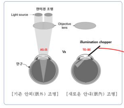 백내장 조명 방식의 차이