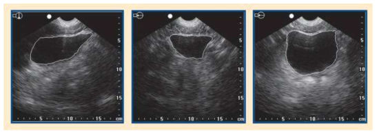 Bladder estimation using ultrasound tomography