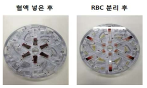 혈액을 디스크에 넣은 후 사진 (좌), 정상적인 RBC 분리 후 사진 (우)