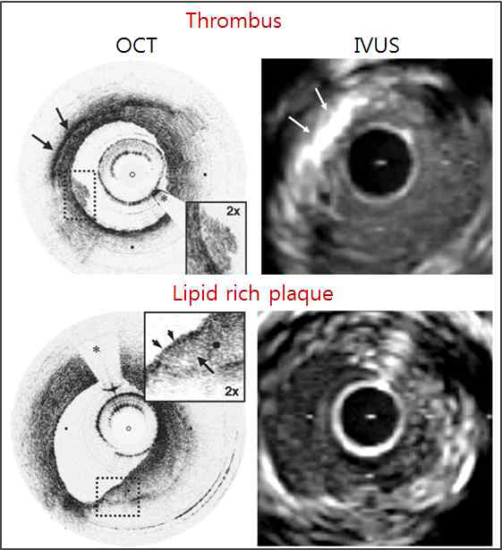 OCT vs. IVUS 영상 비교