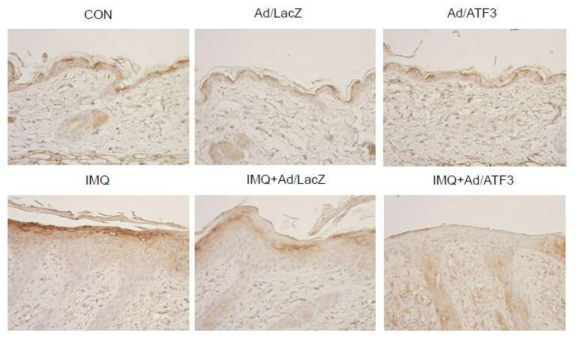 ATF3 과발현에 의한 각질형성세포 분화 억제 효과