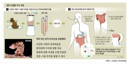 대변 이식술의 개요